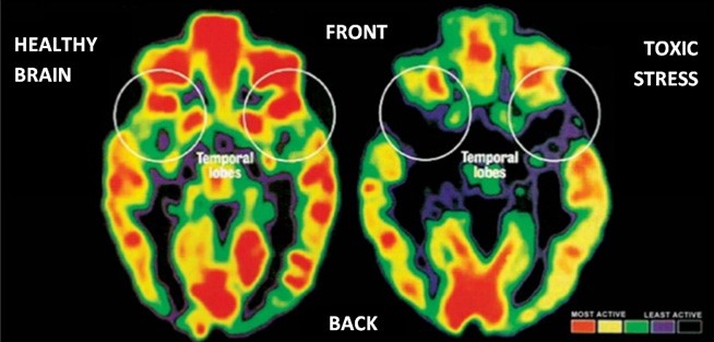 Toxic Stress and its Lifelong Health Consequences - Salud America